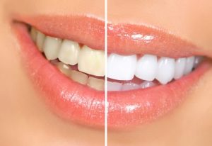 teethwhitening1-1-400x275